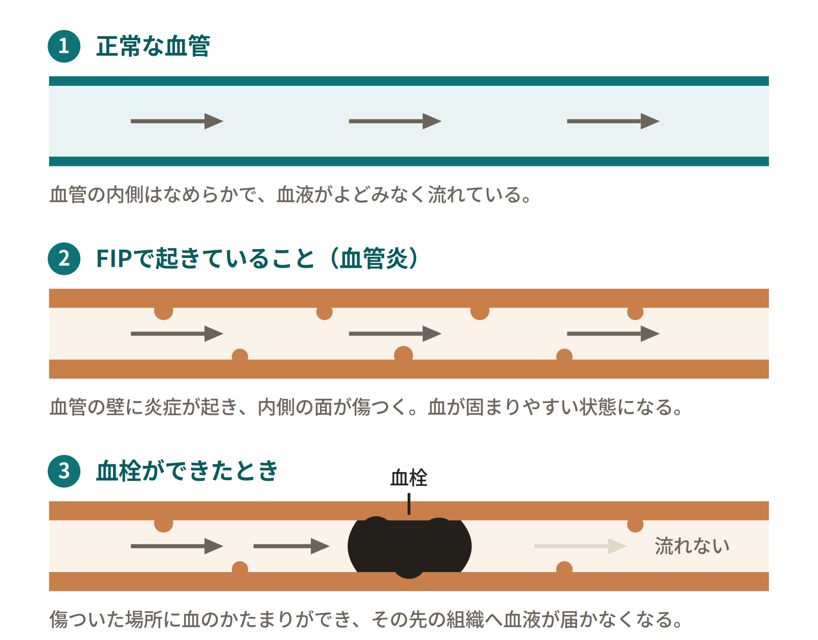 血管の中で血栓ができるまでの3段階。正常な血管、FIPによる血管炎で内側が傷ついた血管、傷ついた場所に血栓ができて血流が止まった血管を、上から順に並べた模式図。
